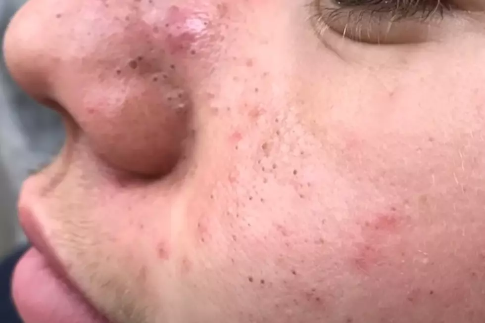 Stressed? Let These Dr. Pimple Popper Videos Soothe You